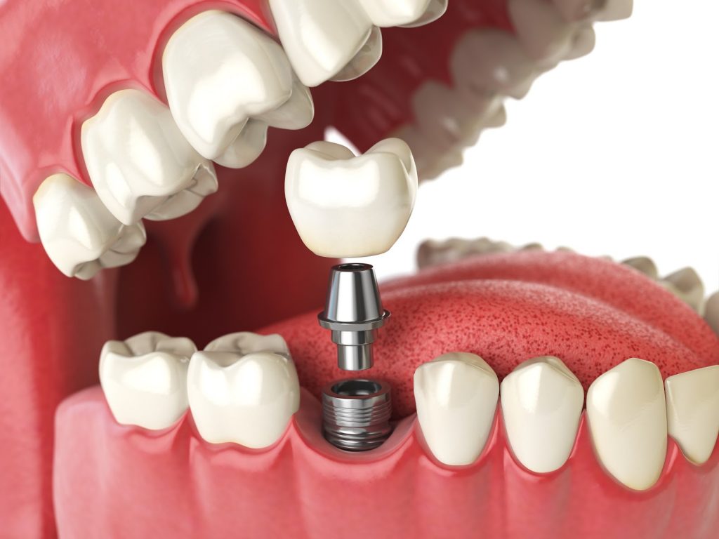 Dental Implants Complete Guide