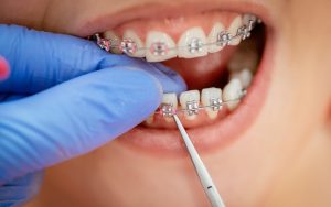 Orthodontic treatment