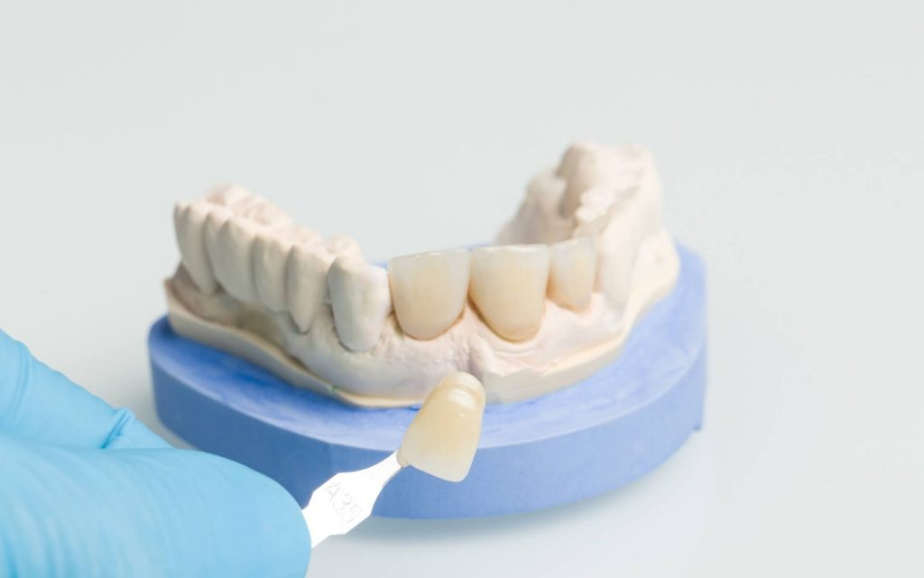 Dental Crowns